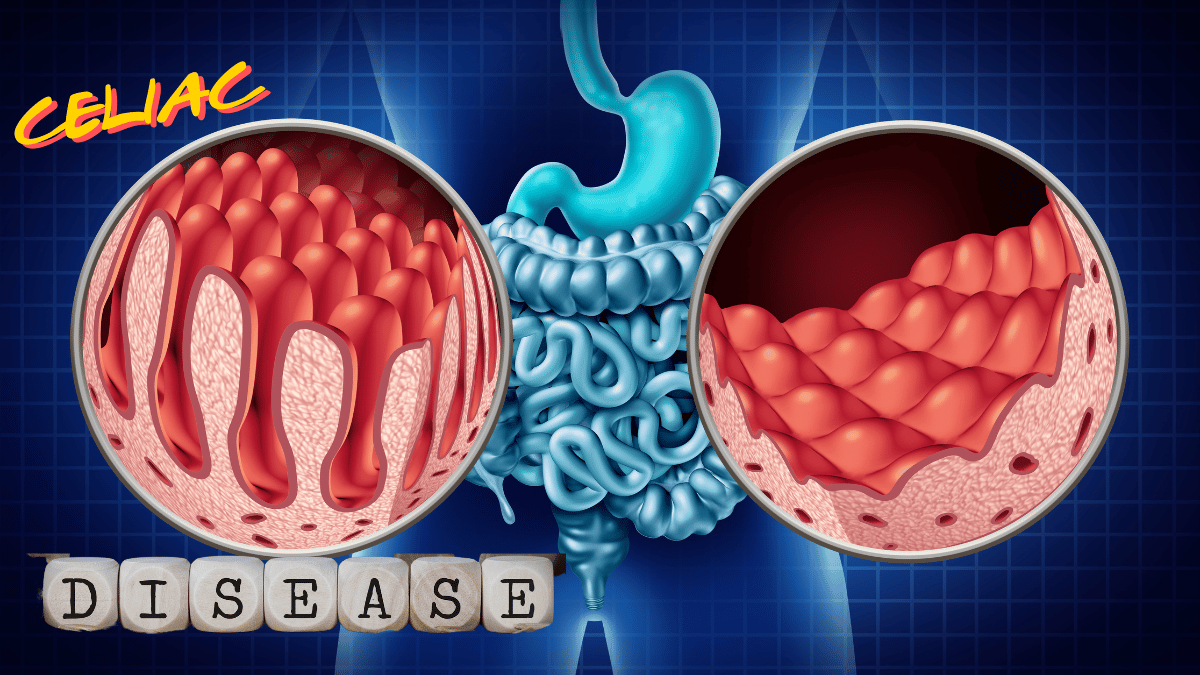 Celiac Disease Symptoms, Diagnosis, and Management