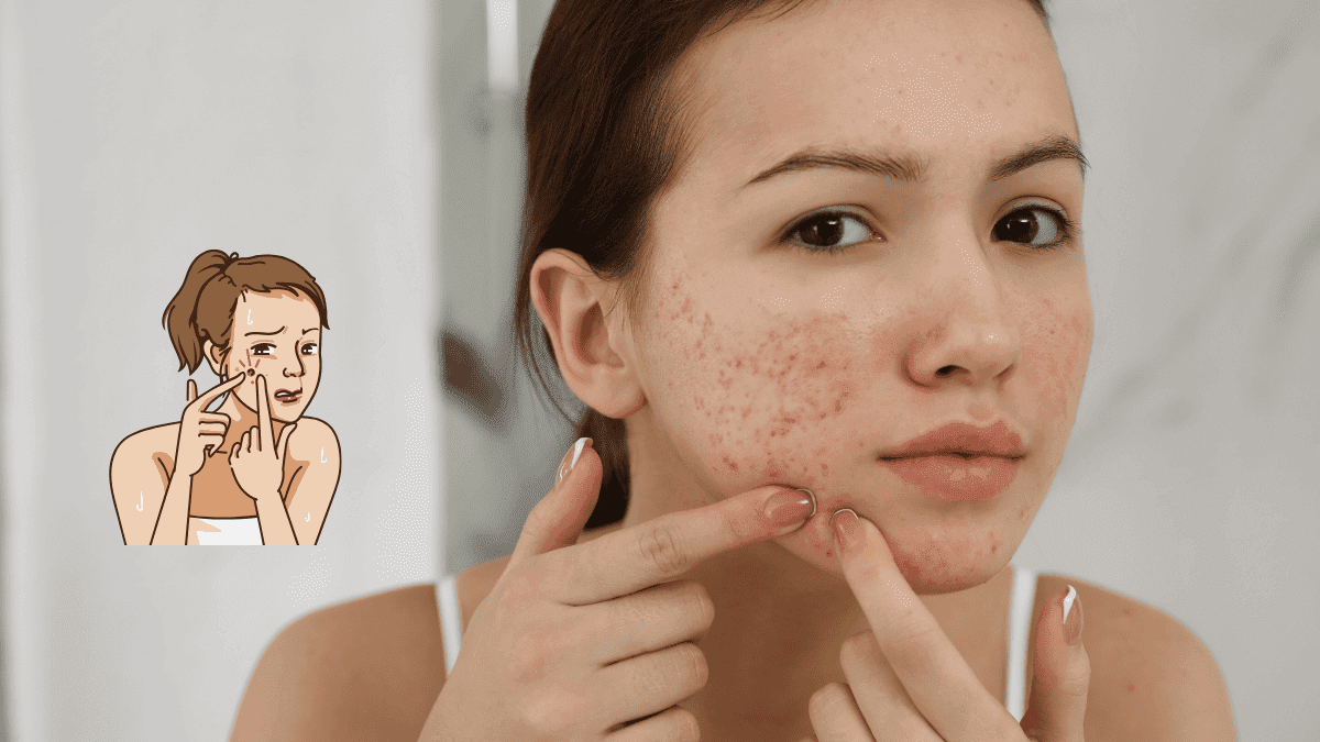 Effective Acne Treatment Clear Your Skin Naturally