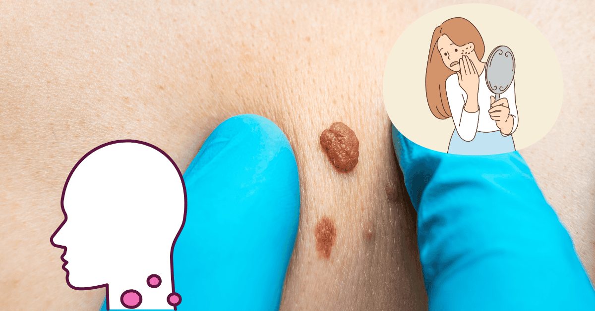 What Causes Skin Tags? Understanding the Triggers and Risk